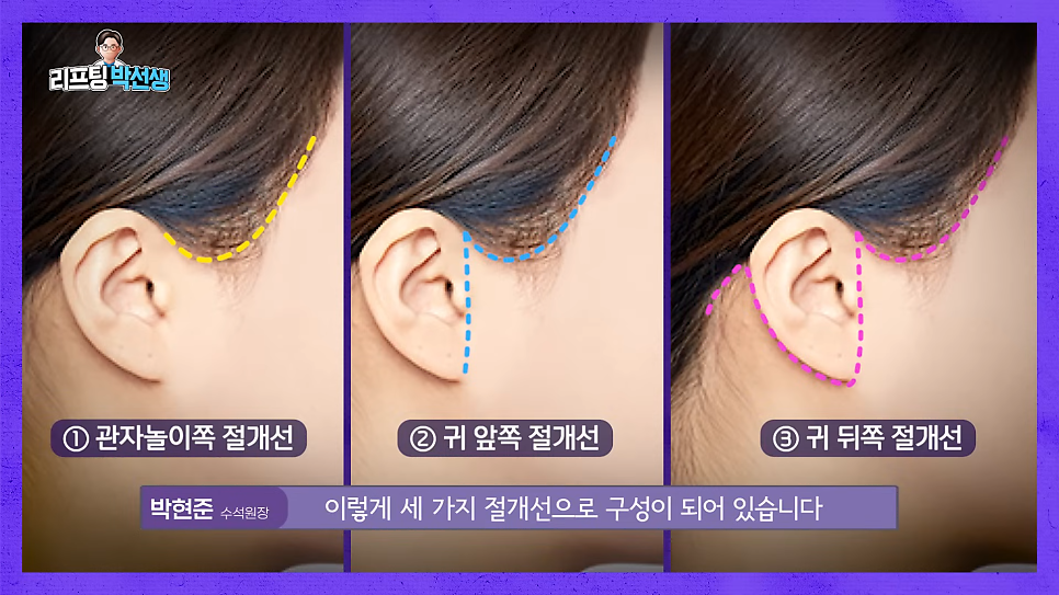 미니리프팅가격, 강남안면거상성형외과에서 보는 겨울 전 탄력 관리의 정밀 설계 관련 이미지 10