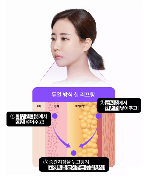 Facial Sagging Lift: Where to Start? Step-by-Step Elasticity Care Beginning with Apgujeong Thread Lifting image 7