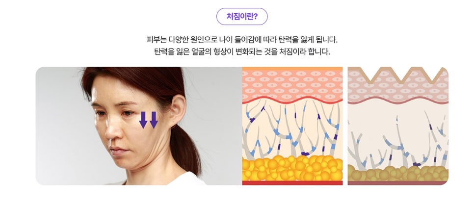 Midlife Brow Lift Review: The Reason Your Expression Looks Droopy Can Be Improved image 3