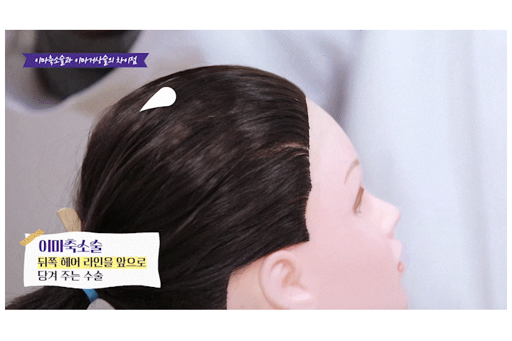 광주성형외과 이마리프팅으로 동안 인상되찾기 관련 이미지 15