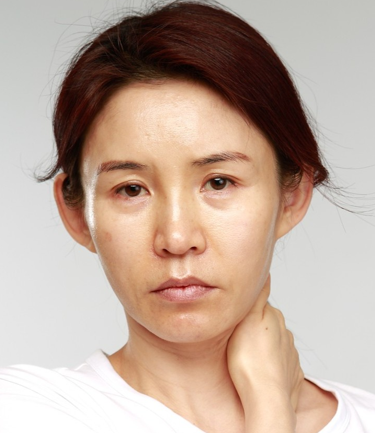 리팅 미니리프팅 맞춤형 노화솔루션 필요한 이유 관련 이미지 2