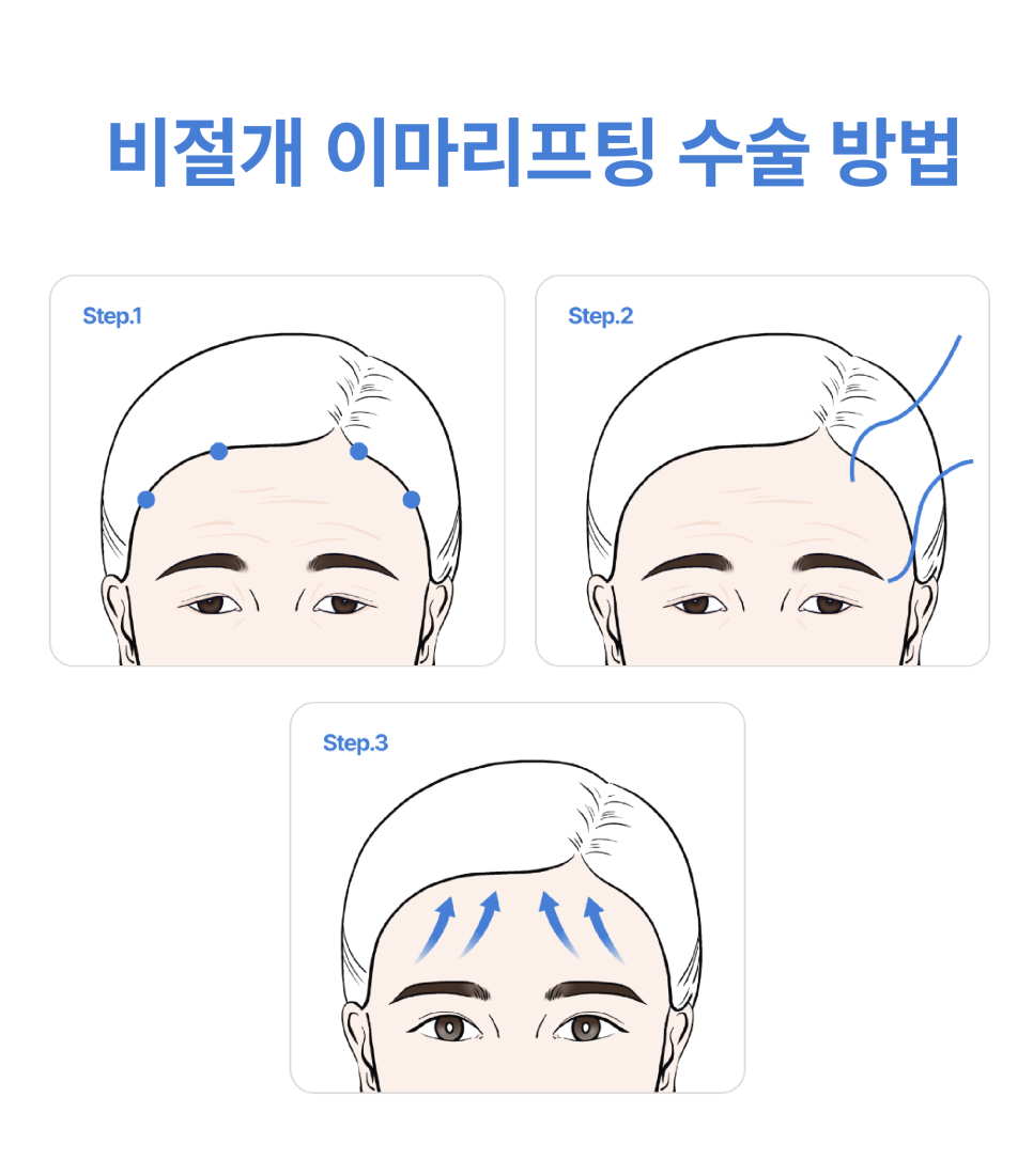 신사이마리프팅으로 달라지는 동안 한끗, 리프팅성형외과 전문의가 밝히는 결정적 차이 관련 이미지 10