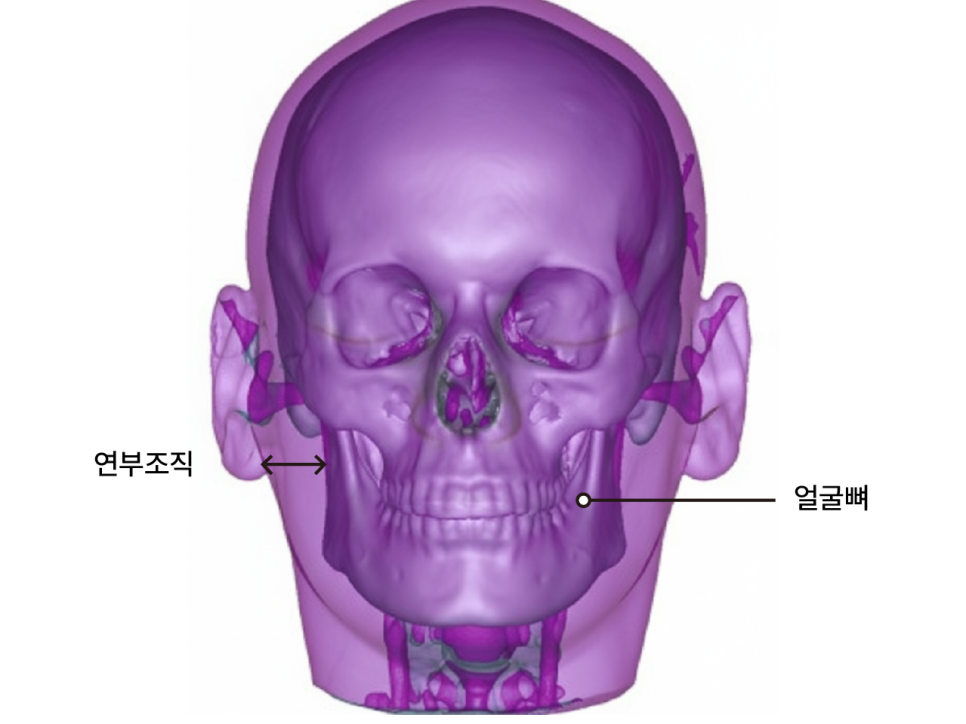 뼈 절제 없이 얼굴선 정돈, 안면윤곽수술의 또 다른 해석 | 리팅미니윤곽술 관련 이미지 17