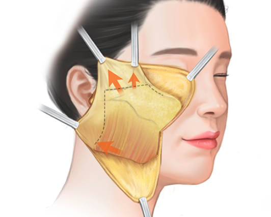 The Difference in Price Between Seoul Facelift and Mini Lifting: How to Choose a Lifting Procedure Wisely in Summer image 9