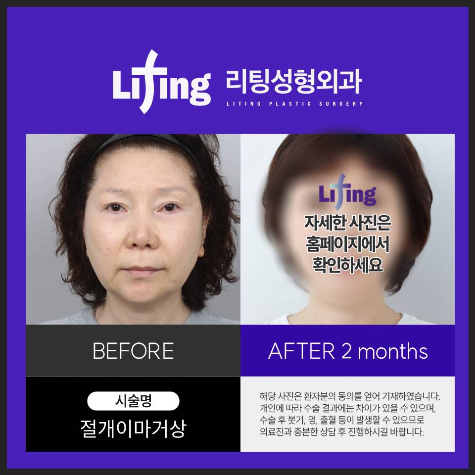 이마거상재수술? 고려하기 전에 핵심을 알아야 합니다 관련 이미지 7