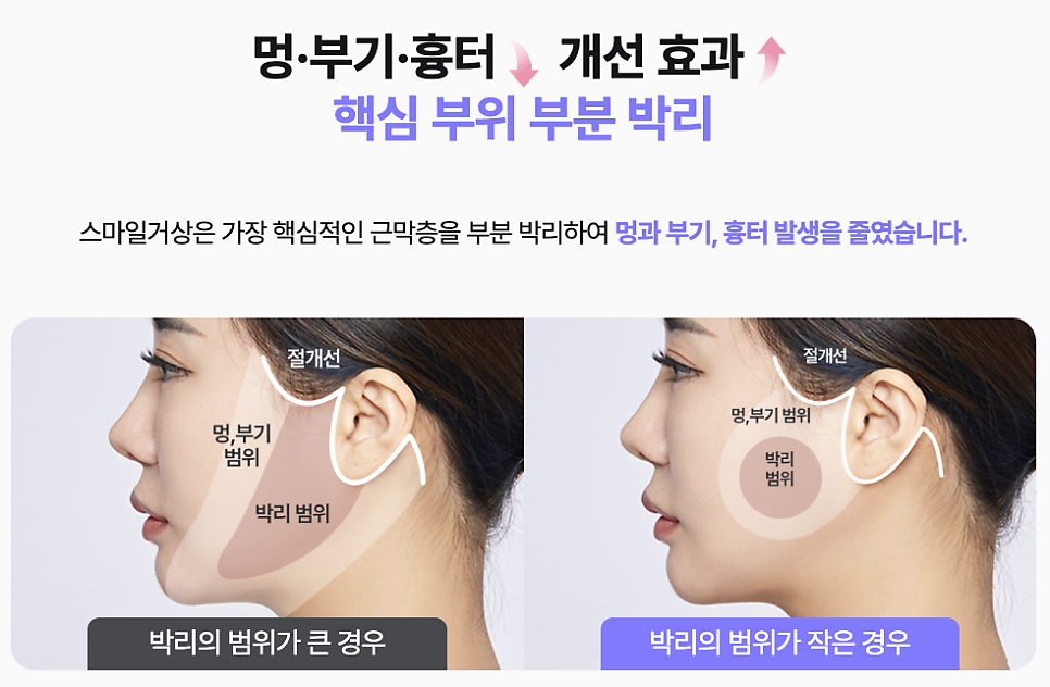 강남역성형외과 스마일거상 볼륨까지 살리는 반거상 리프팅의 핵심은? 관련 이미지 13