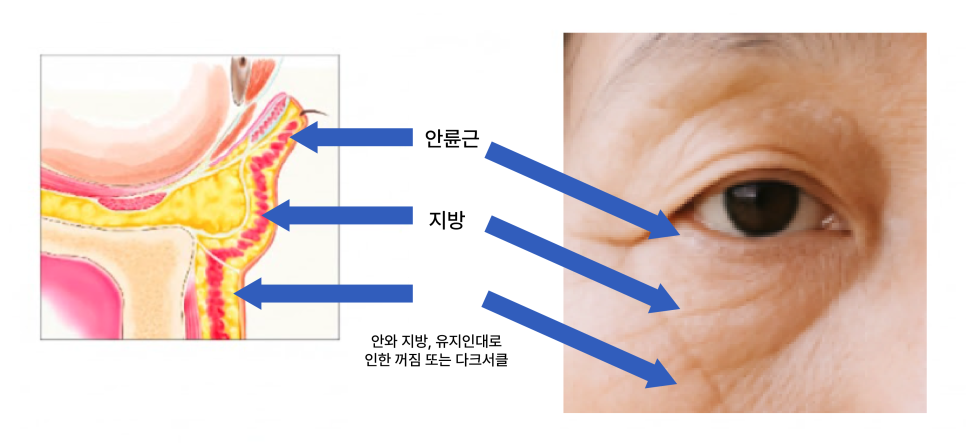 Understanding Gangnam Under-Eye Fat Repositioning, Causes of Hollow Under Eyes, and How the Structure Around the Eyes Changes with Age image 3