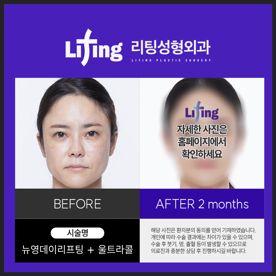 안면거상 뜻을 제대로 알고 수술을 받아야 하는 이유? 관련 이미지 5