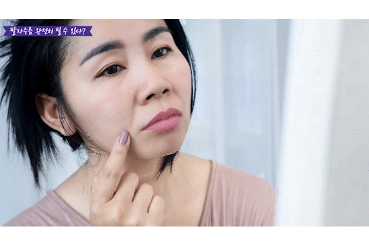 Is There a Natural Way to Look Younger by Getting Rid of Nasolabial Folds at Seoul Liting? image 13