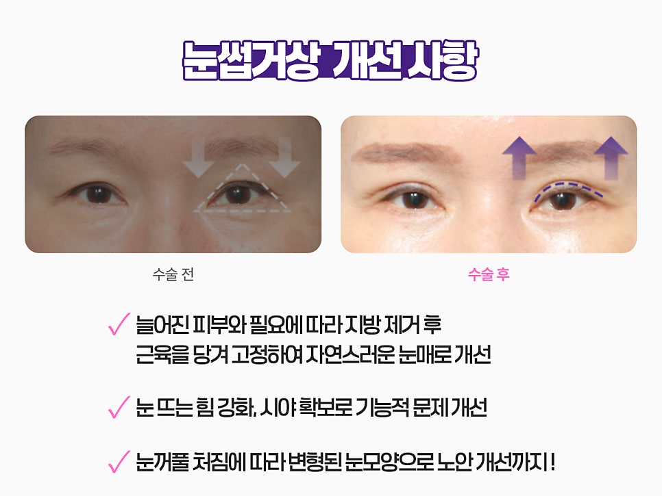 눈썹거상술 비용 가격 알고 싶다면 관련 이미지 10