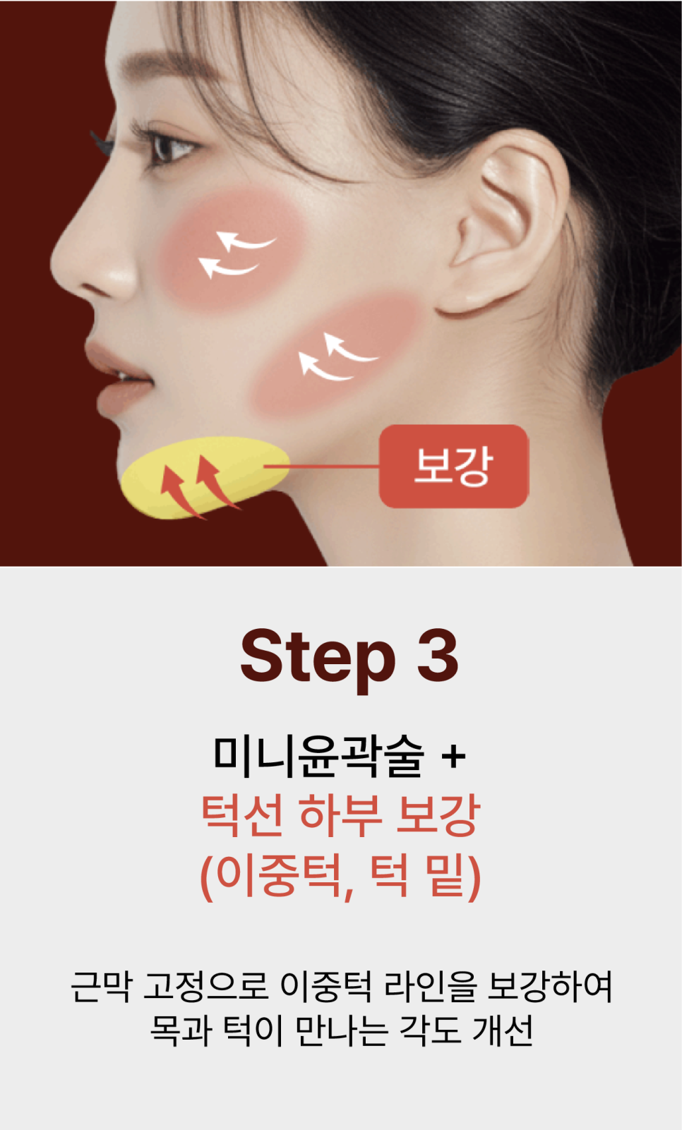 윤곽성형을 고민하게 되는 광대콤플렉스, 원인은 뼈만이 아닙니다 관련 이미지 14
