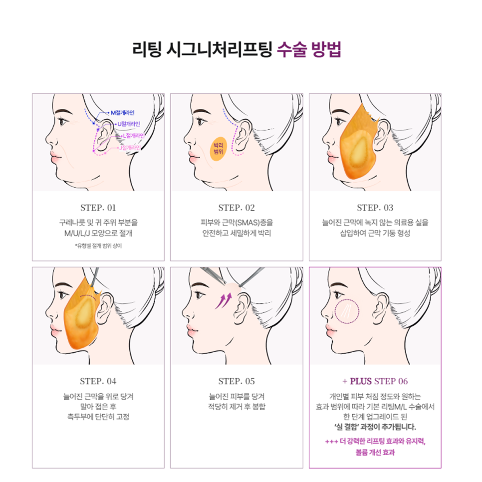 심부볼 마리오네트 확실한 주름개선, 강남성형외과 리팅 시그니처 리프팅? 관련 이미지 6