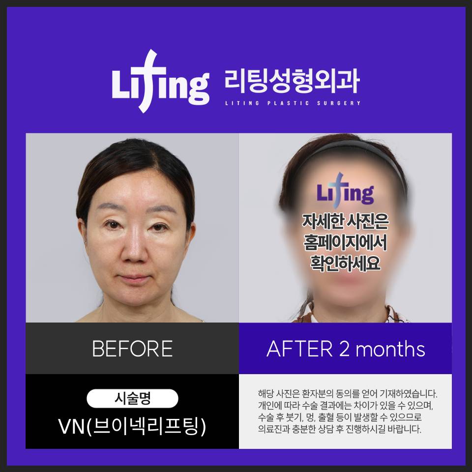 중년리프팅 오래가는 강력한 리프팅 관련 이미지 4