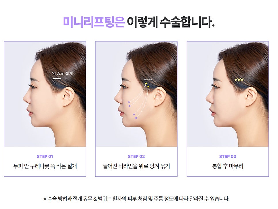리팅 미니리프팅 맞춤형 노화솔루션 필요한 이유 관련 이미지 8