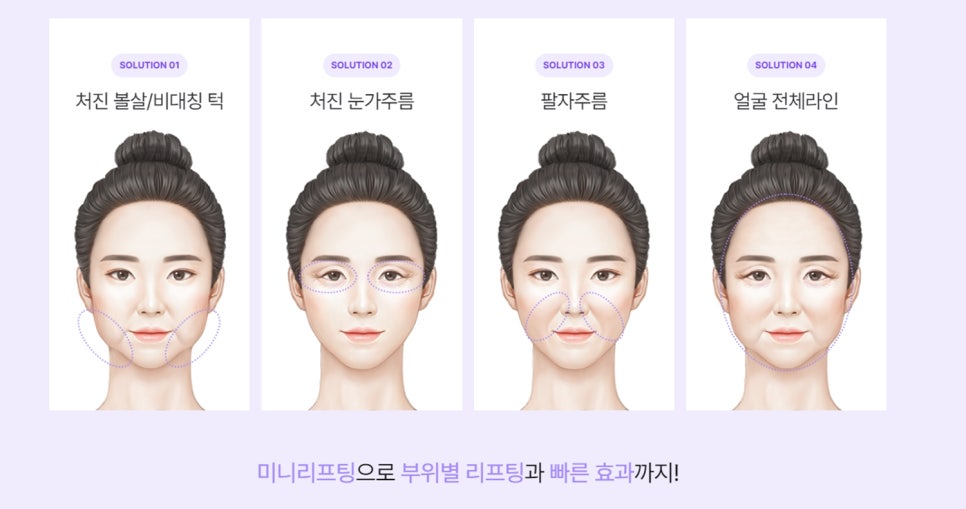 `리팅성형외과가 말하는 미니리프팅 핵심은 관련 이미지 4