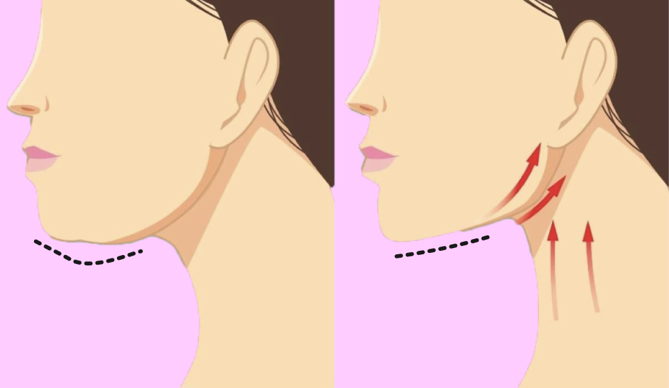 이중턱살시술, 처진얼굴리프팅후기로 확인하는 겨울철 흐려진 윤곽 라인 관리법 관련 이미지 8