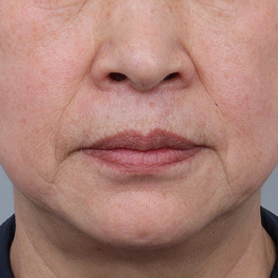 Facelift Gangnam Plastic Surgery Recommendation: Tips Shared by Leeting image 2