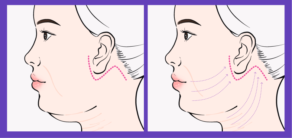 하안부는 왜 먼저 무너질까 청담미니리프팅과 브이라인리프팅의 구조적 접근 관련 이미지 12