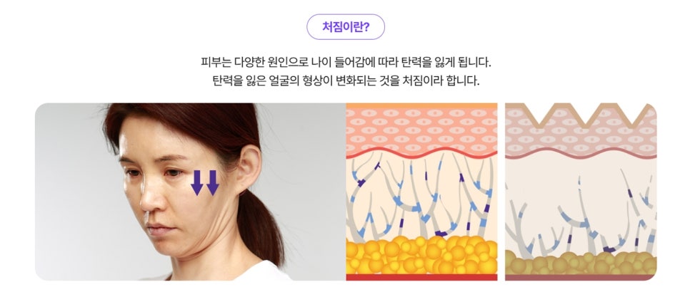 If You’re Worried About a Forward Head Posture Double Chin image 2
