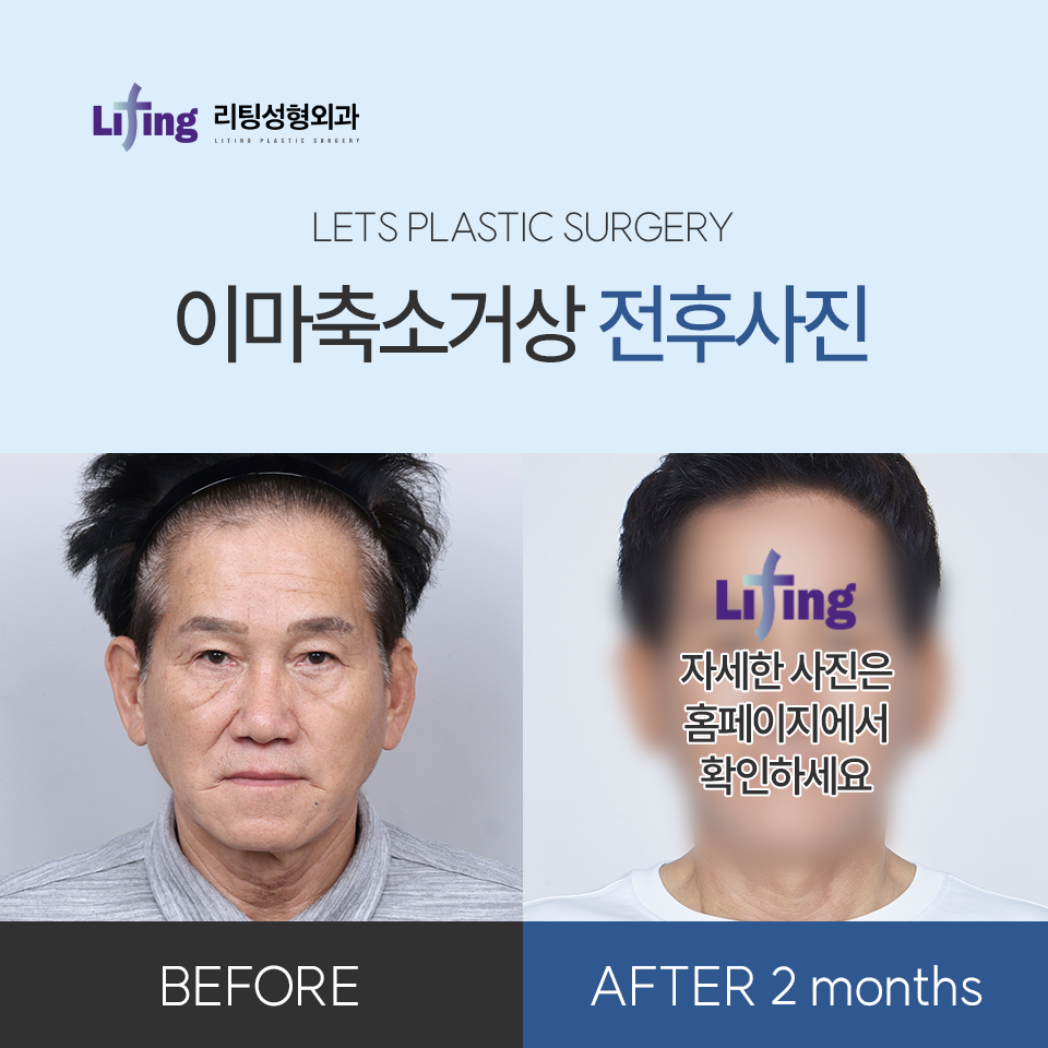 Differences at a Clinic That Does Only Lifting, as Described by Liting Plastic Surgery image 7