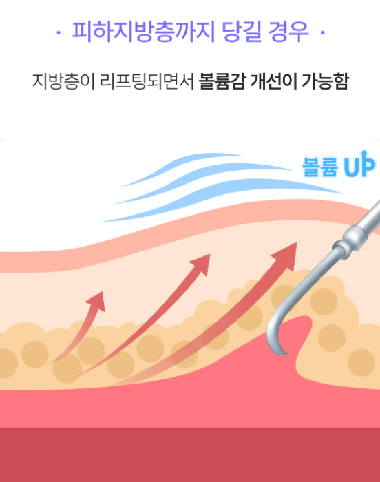 스마일리프팅가격 궁금하다면? 스마일거상과의 차이까지 한번에 정리 관련 이미지 11