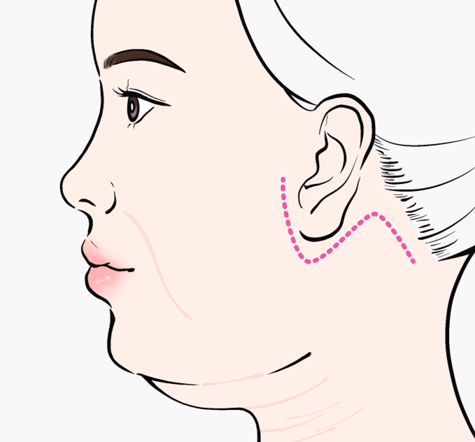 Subtle, Natural Beauty with Facial Wrinkle Lifting at Sinsa Station Leting Plastic Surgery image 7