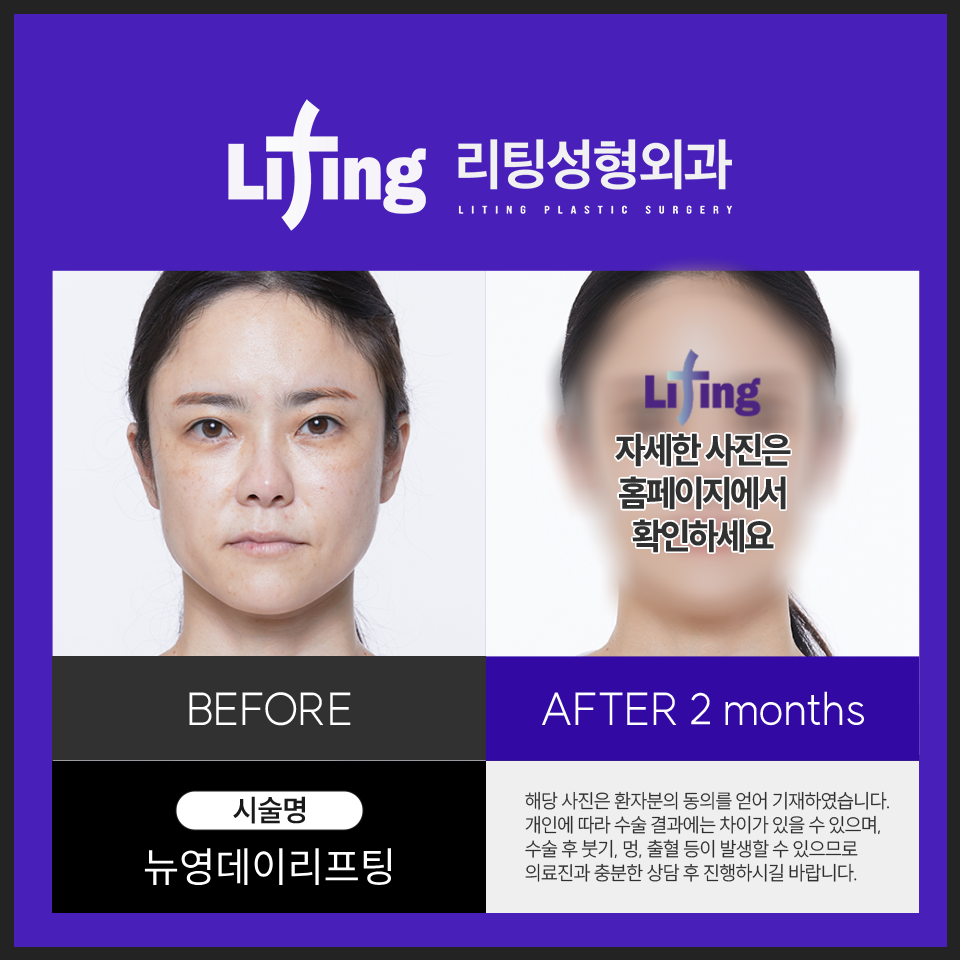 신논현성형외과 리프팅 성공하고 싶으면 2가지 기억하세요 관련 이미지 6