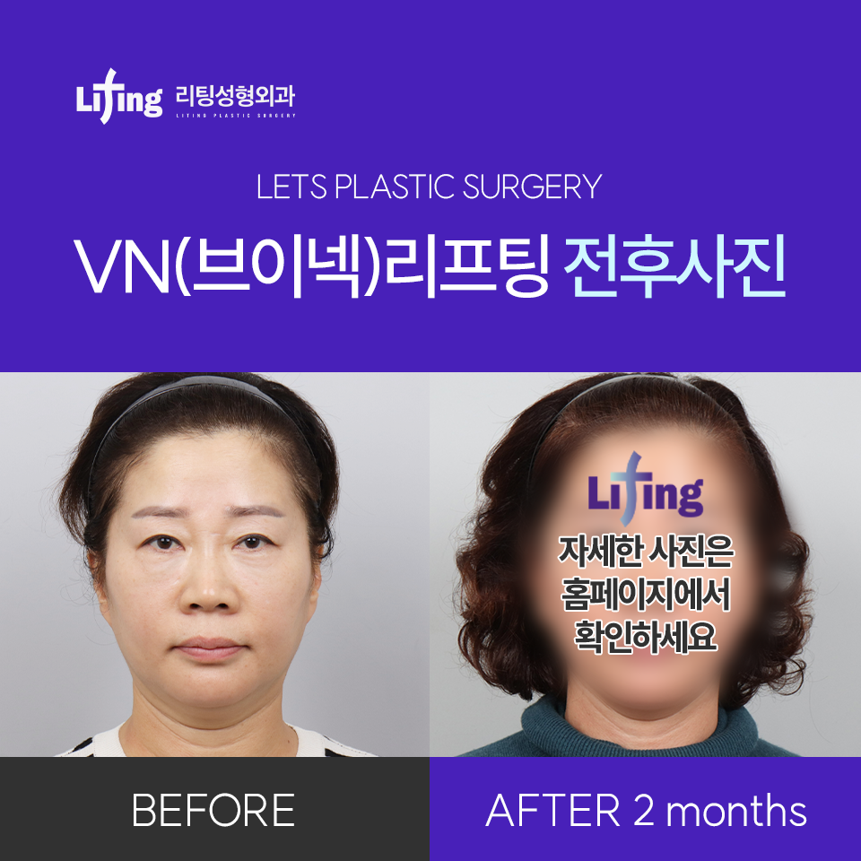 Differences at a Clinic That Does Only Lifting, as Described by Liting Plastic Surgery image 6