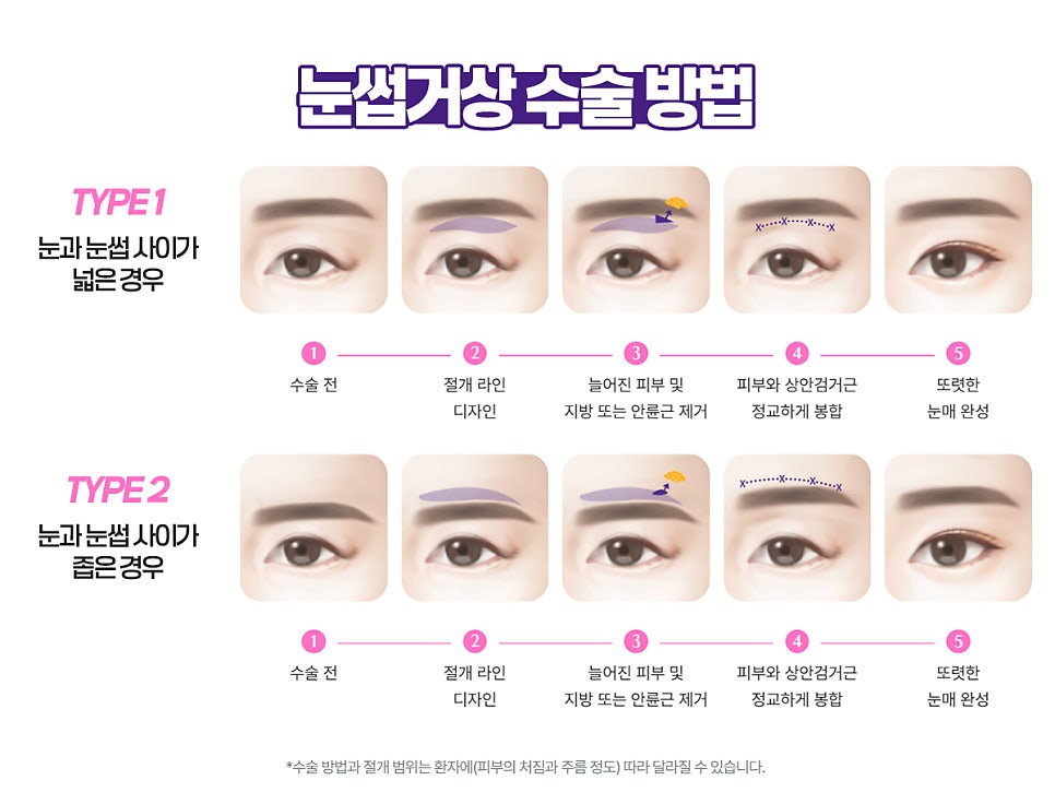 눈썹거상술 비용 가격 알고 싶다면 관련 이미지 9