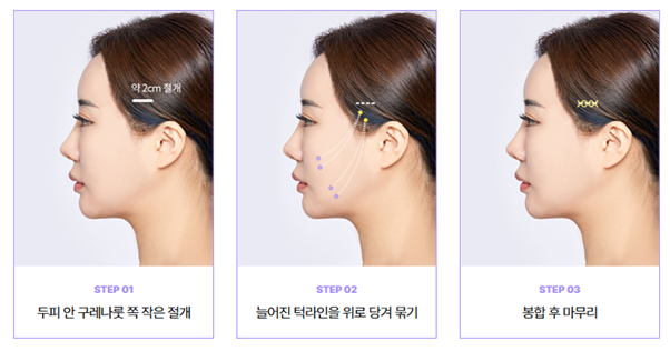 Why Is Mini Facelift Recovery Time in Gangnam Plastic Surgery Possible Over the Weekend? image 13