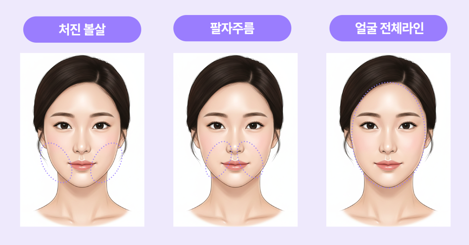 처진볼살리프팅후기에서 시작된 고민, 미니리프팅가격보다 중요한건 ‘방향’입니다 관련 이미지 9