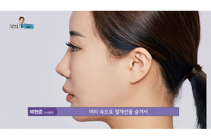 Shinsa Mini Lift, Lifting Plastic Surgery Clinic: Clear Answers to Frequently Asked Questions About Smile Lifting! image 3