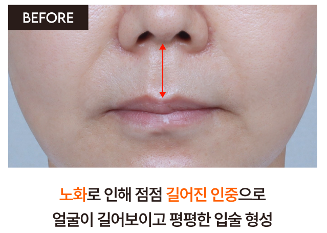 인중축소수술후기로 보는 얼굴 중심 비율의 재조정 ｜ 신사리프팅성형외과의 섬세한 접근 관련 이미지 4