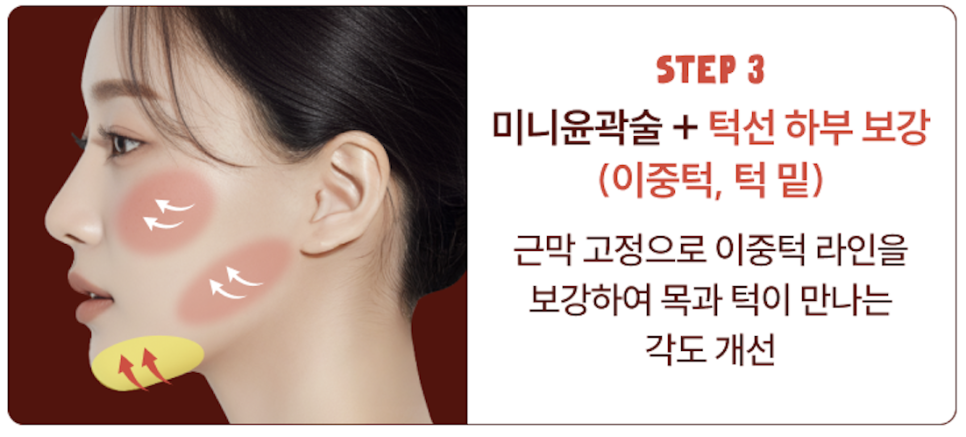 심부볼제거와 안면윤곽수술, 얼굴의 흐름을 디자인하는 리팅성형외과 서울점 또 다른 방법 관련 이미지 11
