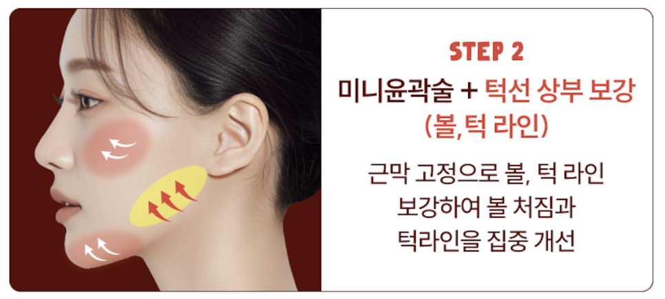 심부볼제거와 안면윤곽수술, 얼굴의 흐름을 디자인하는 리팅성형외과 서울점 또 다른 방법 관련 이미지 10