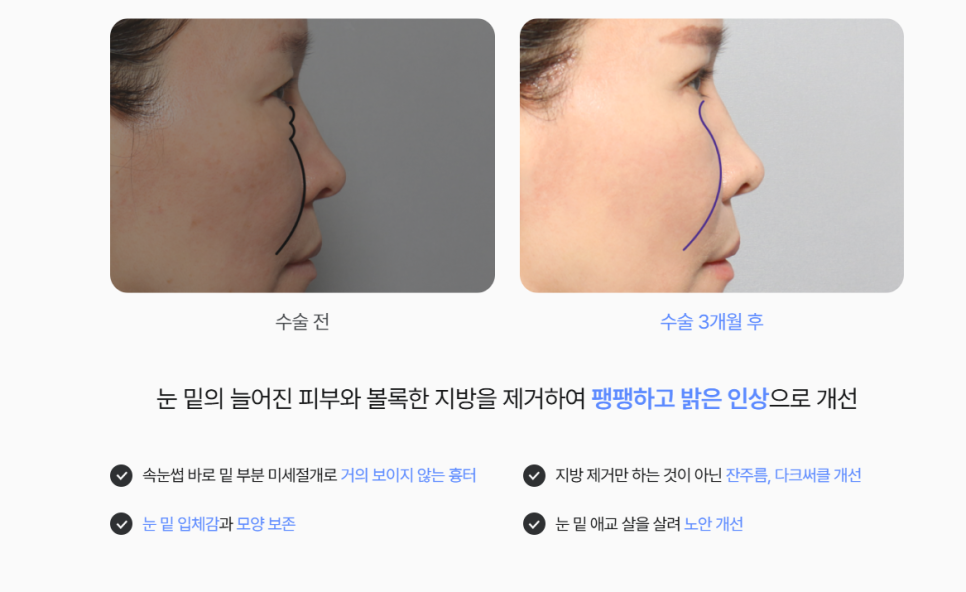 하안검수술흉터 연고, 울퉁불퉁한 눈 밑 흉터 걱정 없이 개선하는 방법 관련 이미지 5