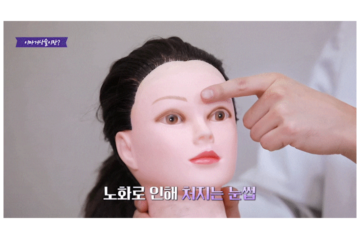 광주성형외과 이마리프팅으로 동안 인상되찾기 관련 이미지 5