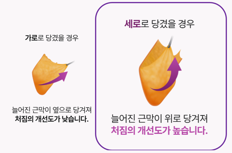 Facelift Gangnam Plastic Surgery Recommendation: Tips Shared by Leeting image 7