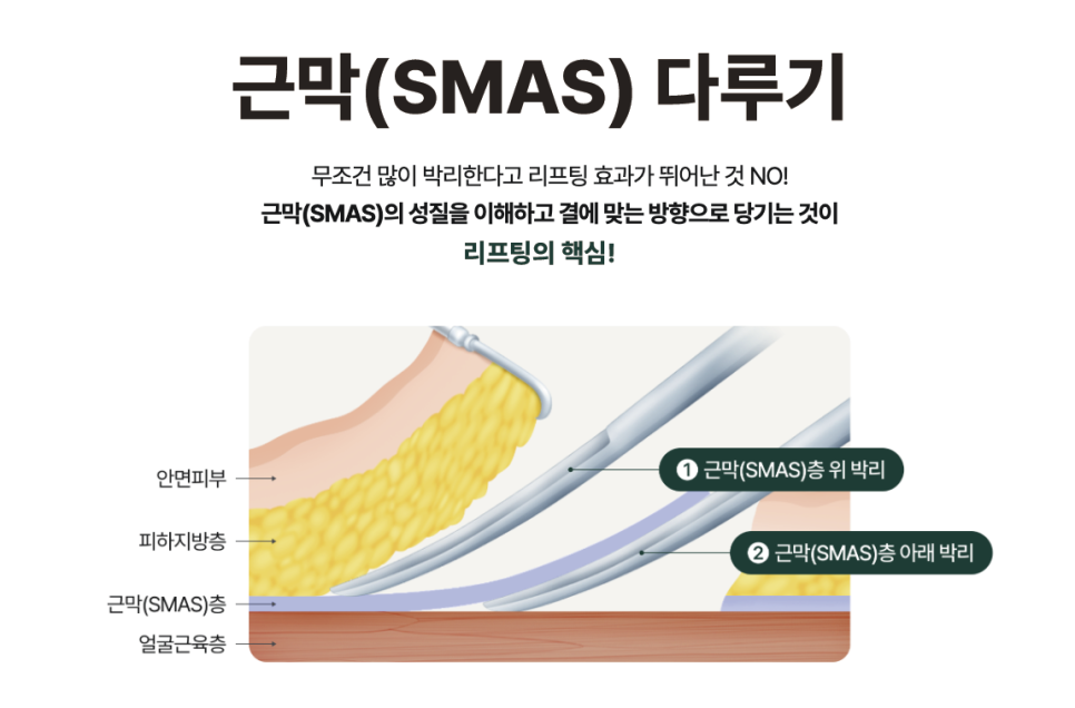 인천성형외과, 목주름리프팅 없이 안면거상만? 효과 놓치기 쉬운 리프팅의 핵심! 관련 이미지 8