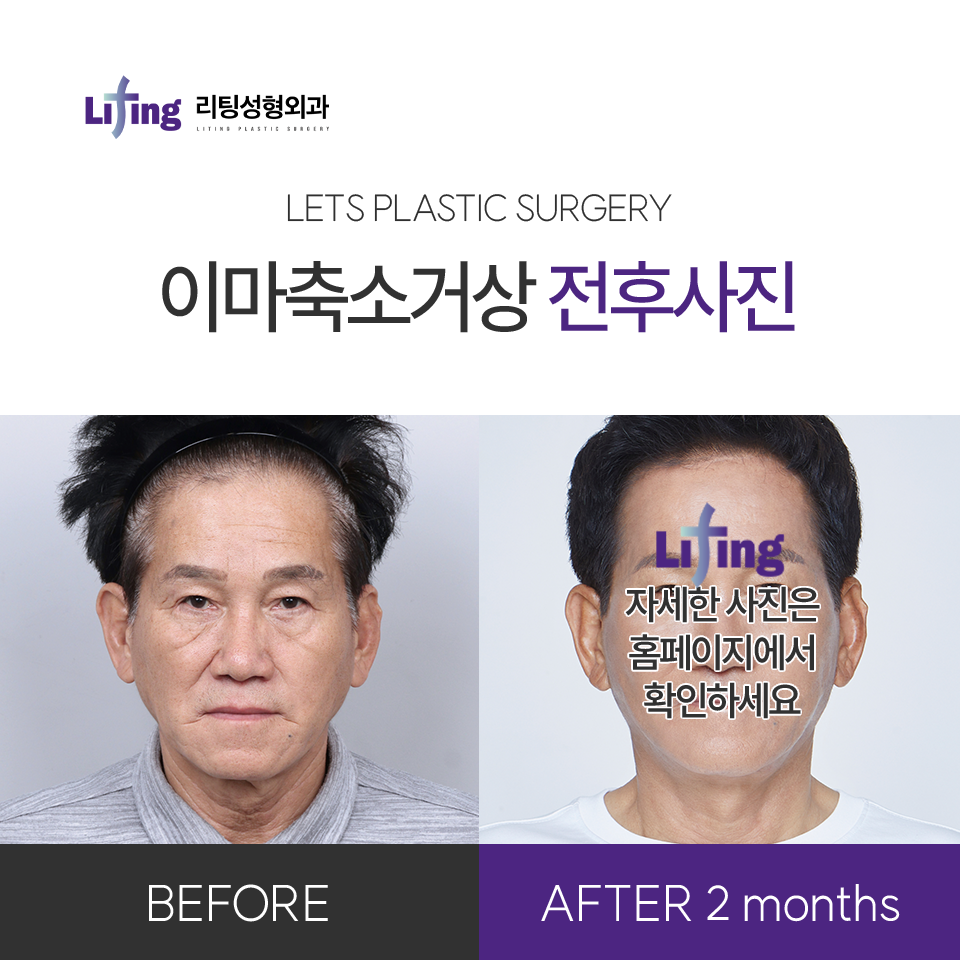 Forehead Lift Recovery Period? You Should Know Before Surgery image 8