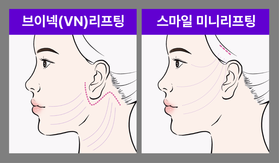 이중턱살시술, 처진얼굴리프팅후기로 확인하는 겨울철 흐려진 윤곽 라인 관리법 관련 이미지 13