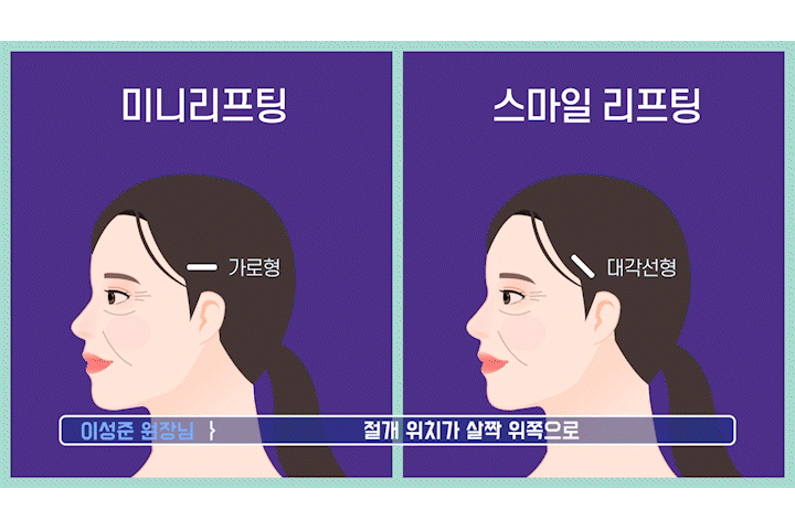 Smiley Lift, How to Improve Midface Sagging While Reducing Incision 부담｜Sinsa Lifting Plastic Surgery Clinic image 6