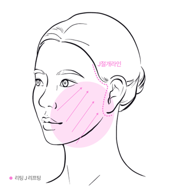 Seoul Liting Plastic Surgery Double Chin Removal: How Can a Blurry Jawline Be Restored? image 9