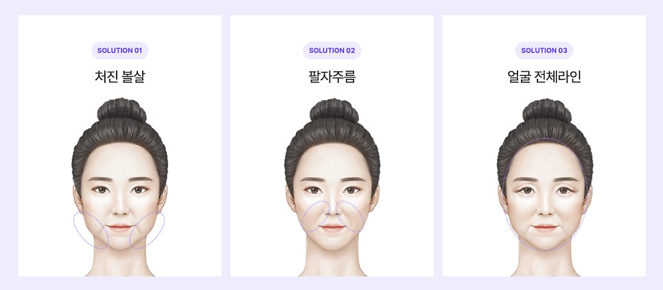 팔자주름수술 필러로는 부족할 때 미니리프팅가격도 체크해보세요 관련 이미지 18