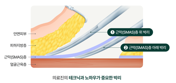 턱살리프팅, 강남역성형외과 여름다이어트 얼굴선 관리하는 법 관련 이미지 7