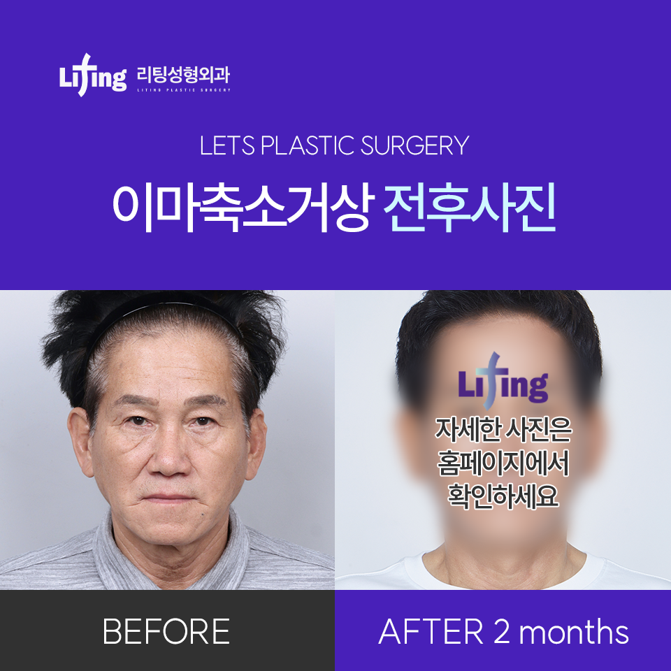 You may regret proceeding based only on the price of a brow lift image 9