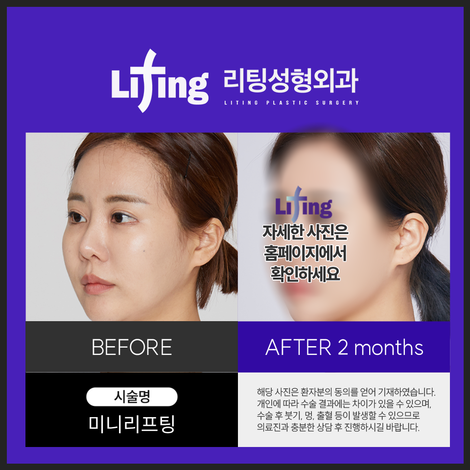 미니안면거상? 이 글로 종결합니다 관련 이미지 9