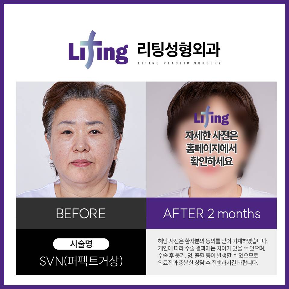 안면거상성형외과 선택 기준 알려 드립니다 관련 이미지 4