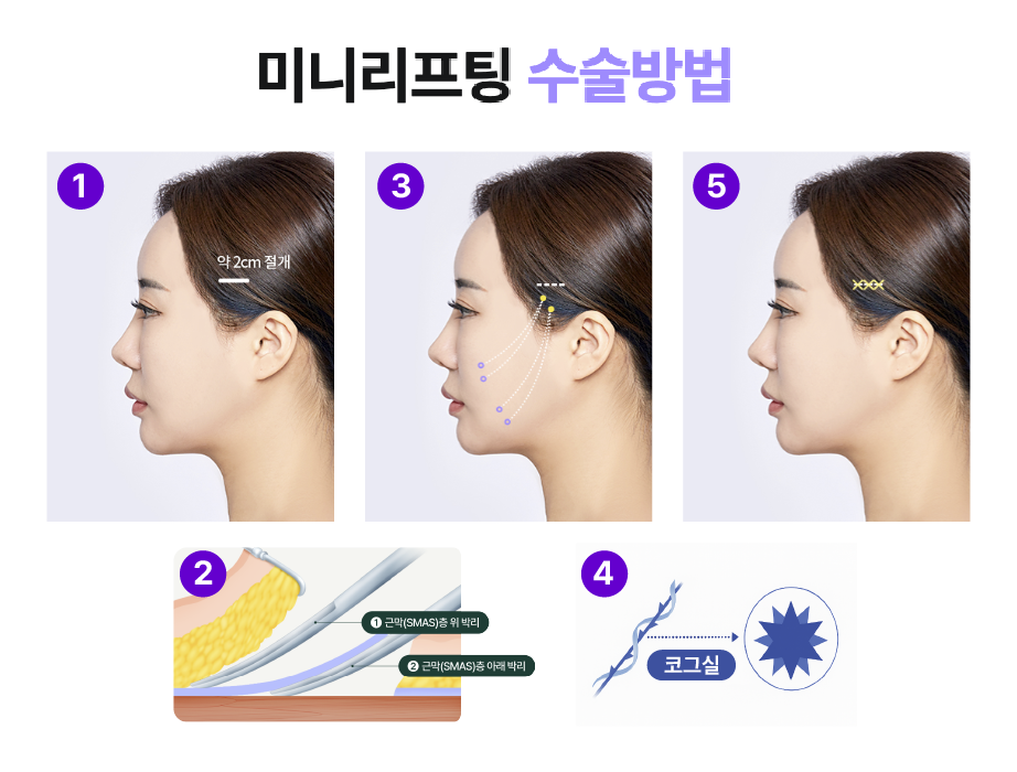 팔자주름수술 필러로는 부족할 때 미니리프팅가격도 체크해보세요 관련 이미지 16
