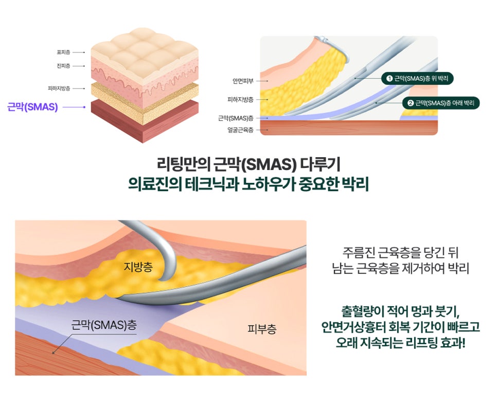 From Face to Neck, Naturally: If You’re Worried About Facelift Scars, Visit a Gangnam Lifting Clinic image 4